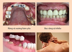 Niềng răng là gì và có thực sự thần kỳ chữa hết hô, móm?