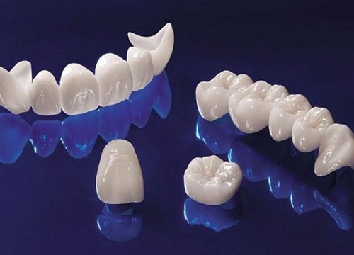 Bật mí mẫu răng sứ tốt nhất khi cấy ghép Implant