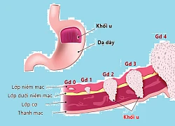 Các loại ung thư khó phát hiện sớm