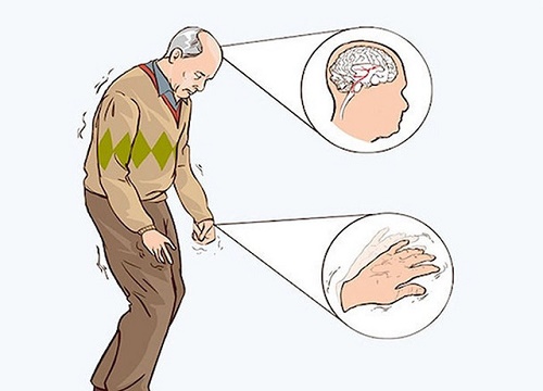 Dùng sóng nhiệt kích thích tiền đình trong điều trị bệnh parkinson