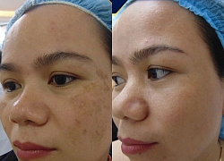 Thực sự uống collagen có phải là "thần dược" trị nám?