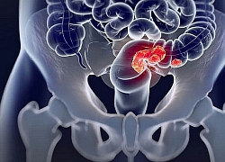 Ung thư đại tràng là gì? Nguyên nhân, triệu chứng và cách điều trị ung thư đại tràng