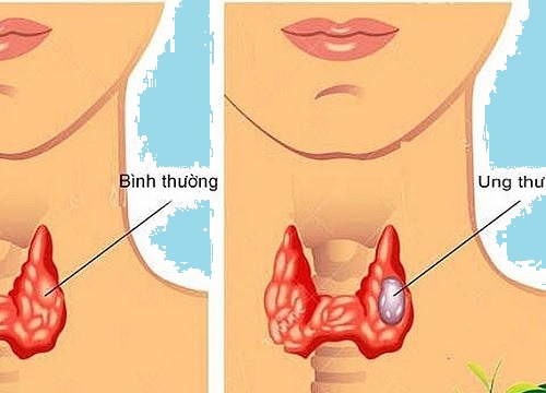 Ung thư tuyến giáp là gì? Nguyên nhân, triệu chứng và cách điều trị ung thư tuyến giáp