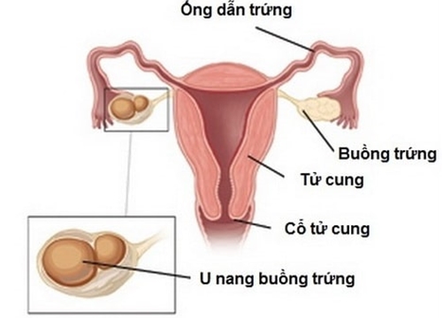 U nang buồng trứng và thai nghén