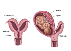 Bị vách ngăn tử cung thì làm thụ tinh nhân tạo có thành công cao không?