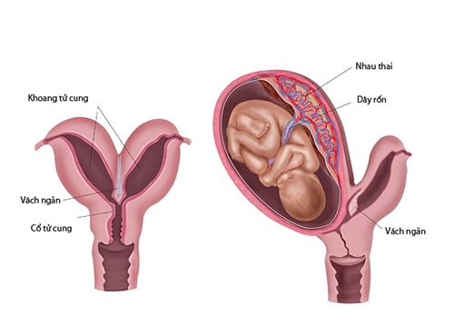 Bị vách ngăn tử cung thì làm thụ tinh nhân tạo có thành công cao không?