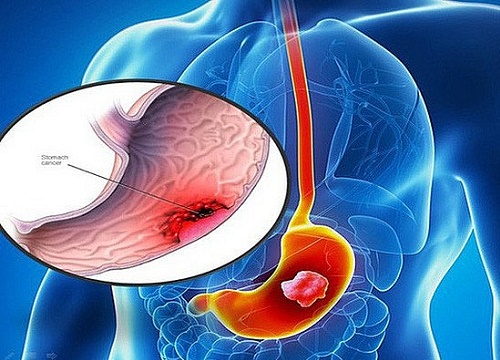 Phương pháp mới nhất trong điều trị ung thư dạ dày