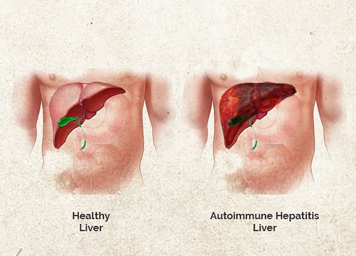 Nguyên nhân, triệu chứng, chẩn đoán bệnh viêm gan tự miễn