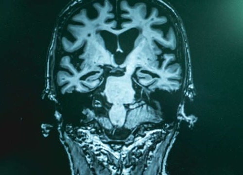 Xét nghiệm máu phát hiện bệnh Alzheimer ở giai đoạn đầu với độ chính xác 94%