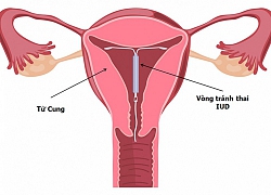 Sau sinh 1,5 tháng có đặt vòng tránh thai được chưa?