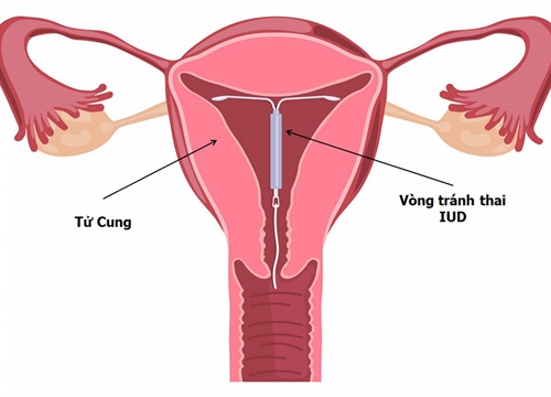 Sau sinh 1,5 tháng có đặt vòng tránh thai được chưa?