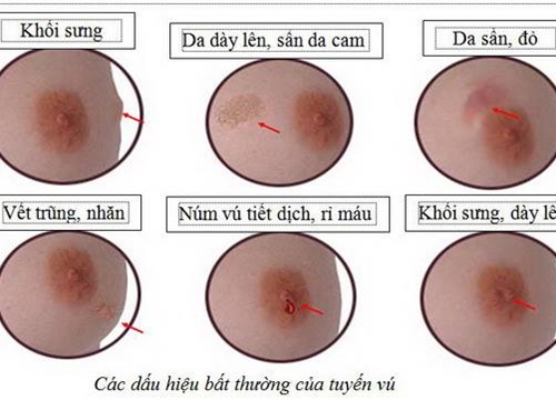 Ung thư vú sống được bao lâu?