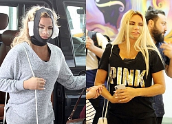 Katie Price lộ mặt sưng phồng sau phẫu thuật thẩm mỹ