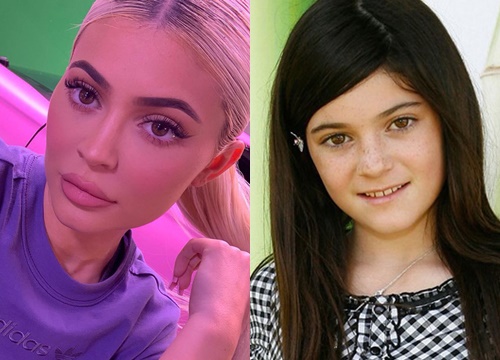 Kylie Jenner tiêm thẩm mỹ môi nhìn cực quyến rũ nhưng Hiệp hội bác sĩ thẩm mỹ Úc lại cảnh báo có nguy cơ gây mù lòa