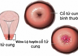 Lộ tuyến cổ tử cung, liệu có dẫn đến ung thư không?