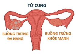 Người bị buồng trứng đa nang có con được không?