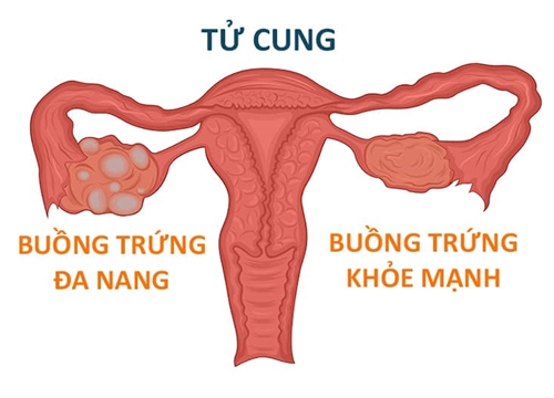 Người bị buồng trứng đa nang có con được không?