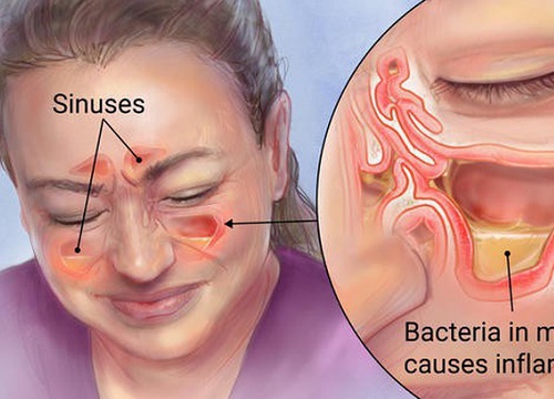 Biến chứng do viêm xoang có thể gây mù mắt, tử vong