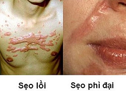 Phân biệt sẹo lồi, sẹo phì đại và cách điều trị hiệu quả