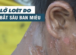 Sợ hãi cảnh trẻ em bị bỏng lở loét do đi bắt sâu ban miêu