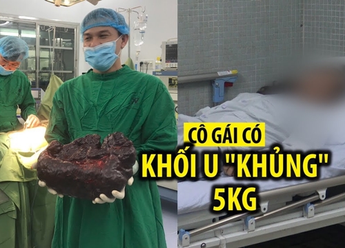 Khối u khủng nặng hơn 5 kg, dài nửa mét trong bụng cô gái