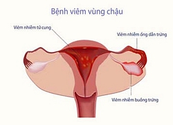 Viêm vùng chậu có biểu hiện nào điển hình không?