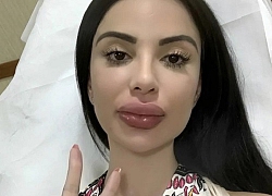 Bản sao Kim Kardashian sưng môi