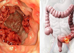 Chàng trai 17 tuổi phát hiện mình bị ung thư trực tràng thông qua những triệu chứng chẳng ai ngờ tới