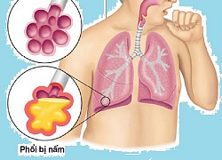 Nấm phổi - căn bệnh nguy hiểm ít người biết