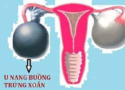 Tưởng con gái đau bụng do rối loạn tiêu hóa, mẹ bất ngờ khi biết sự thật