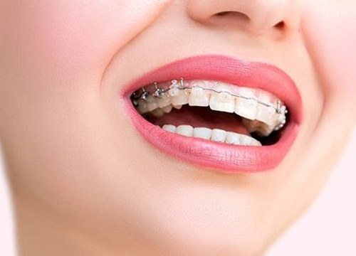 Chưa niềng răng thì bị chê vẩu xấu xí, niềng rồi đi luôn cả hàm