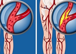 Đây chính là 7 triệu chứng ai cũng nhầm lẫn với các bệnh khác