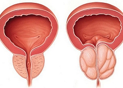 Nam giới xuất hiện 4 dấu hiệu này, có thể là tuyến tiền liệt đang 'kêu cứu'