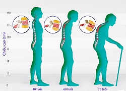 Thói quen đơn giản phòng ngừa loãng xương sớm