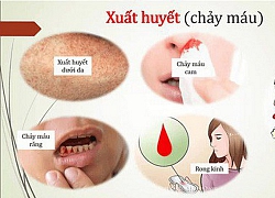 Bác sĩ chỉ rõ 2 biến chứng nguy hiểm của sốt xuất huyết