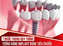 Quy trình 7 bước phẫu thuật cắm ghép Implant theo tiêu chuẩn vô trùng