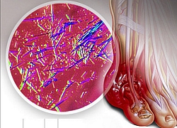 Tăng acid uric máu, không chỉ lo bị gút