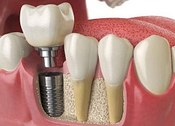 Những điều cần biết khi trồng răng Implant