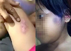 Bé gái bị cha dượng hờ bạo hành có tỷ lệ thương tích 51%
