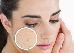 Cách điều trị á sừng mùa hanh khô