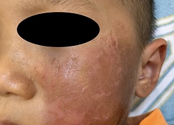 Hóa trang Halloween, bé 4 tuổi bỏng rộp da mặt và khuyến cáo của bác sĩ chuyên khoa