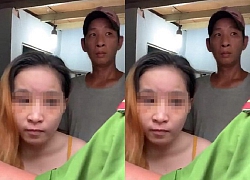 Những vết sẹo ám ảnh của bé gái 6 tuổi bị "chồng hờ" của mẹ đánh đập dã man, gí tàn thuốc vào người