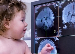 Sinh mổ gây nguy cơ mắc bệnh tự kỷ và rối loạn tăng động giảm chú ý