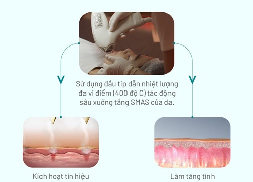 Mezo - công nghệ triệu đô trong điều trị rỗ, nám