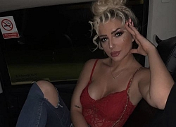 Hot girl tiêm filler để có gương mặt con nhà giàu như Kylie Jenner