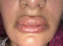 Cô gái bị sưng phồng, cứng đờ môi vì tiêm filler giống Kylie Jenner