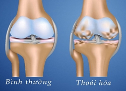 Điều trị thoái hóa khớp gối - Kỳ 1: Bảy nguyên nhân đau đớn