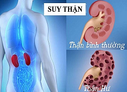 Những "sát thủ" tàn phá thận người Việt biết nhưng vẫn mắc phải