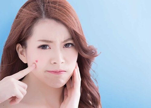 Những bí quyết "vàng" để có một gương mặt sạch mụn