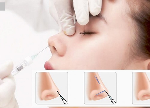 Liên tiếp các ca bị mù do tiêm chất làm đầy giá 2 triệu đồng